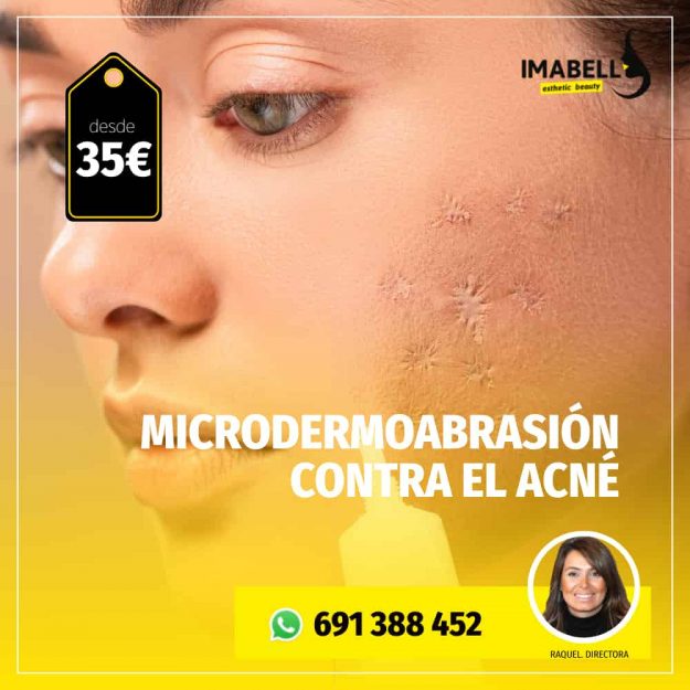 microdermoabrasion contra el acne